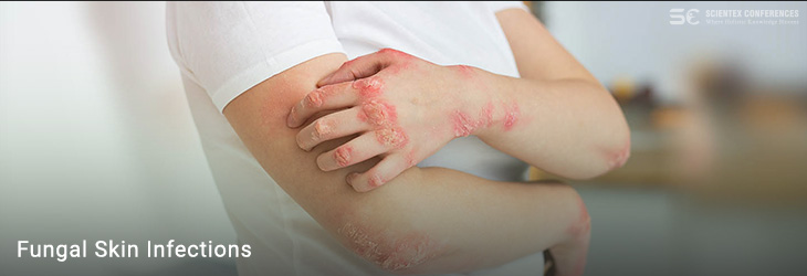 Fungal Skin Infections