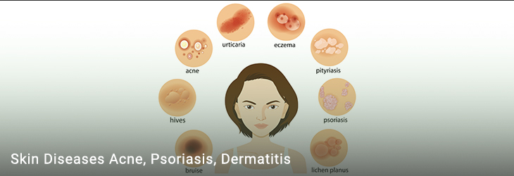 Skin Diseases: Acne, Psoriasis, Dermatitis